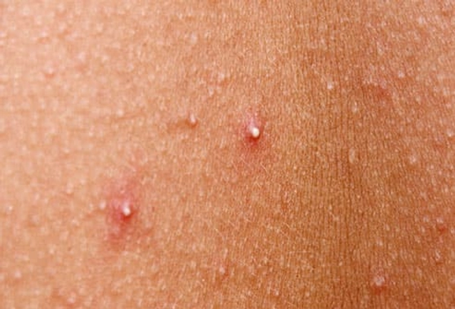 princ rm photo of whiteheads on womans back شرکت زیبایی سلامت دانژه